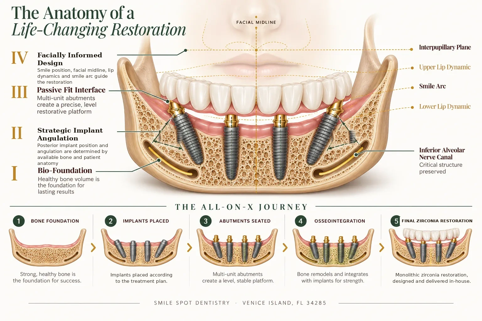 Multi-layered All-on-X full arch implant schematic showing bone foundation, strategic implant angulation, multi-unit abutments, facially informed design and a monolithic zirconia restoration — Smile Spot Dentistry Venice FL