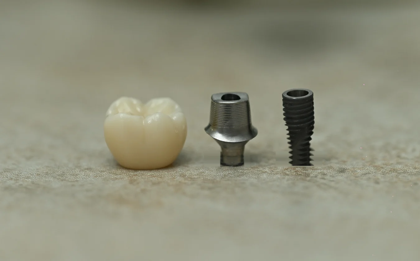 Final ceramic crown with its abutment and implant — Smile Spot Dentistry, Venice, FL