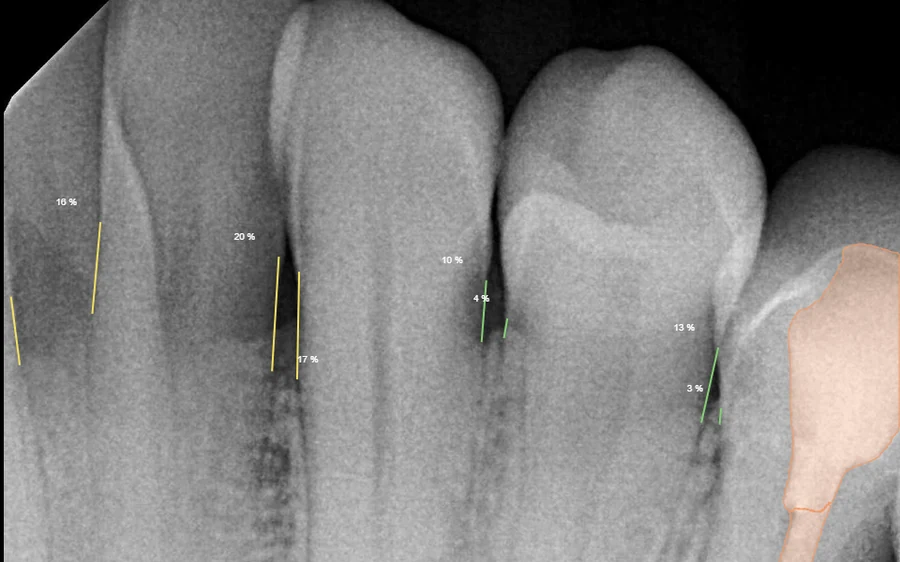 Pearl AI radiograph with bone levels marked around the teeth — Smile Spot Dentistry, Venice, FL