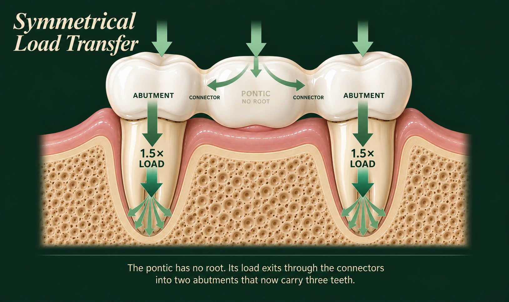 Cross-section of a three-unit dental bridge showing symmetrical load transfer — bite force landing on the rootless pontic splits at the connectors and travels laterally into the two abutment teeth, so each root carries roughly one and a half times its own load before dispersing it into the surrounding bone — Smile Spot Dentistry, Venice FL