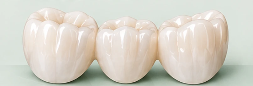 Hand-layered ceramic dental bridge built for individualised esthetics — Smile Spot Dentistry, Venice FL