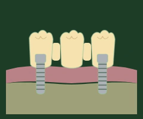 Implant-supported bridge — two titanium implant posts in bone anchoring a fixed span, no natural teeth involved — Smile Spot Dentistry, Venice FL