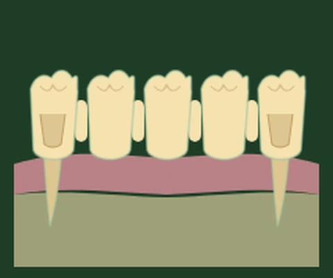 Long-span bridge — two abutment teeth supporting multiple pontics across a wider gap — Smile Spot Dentistry, Venice FL