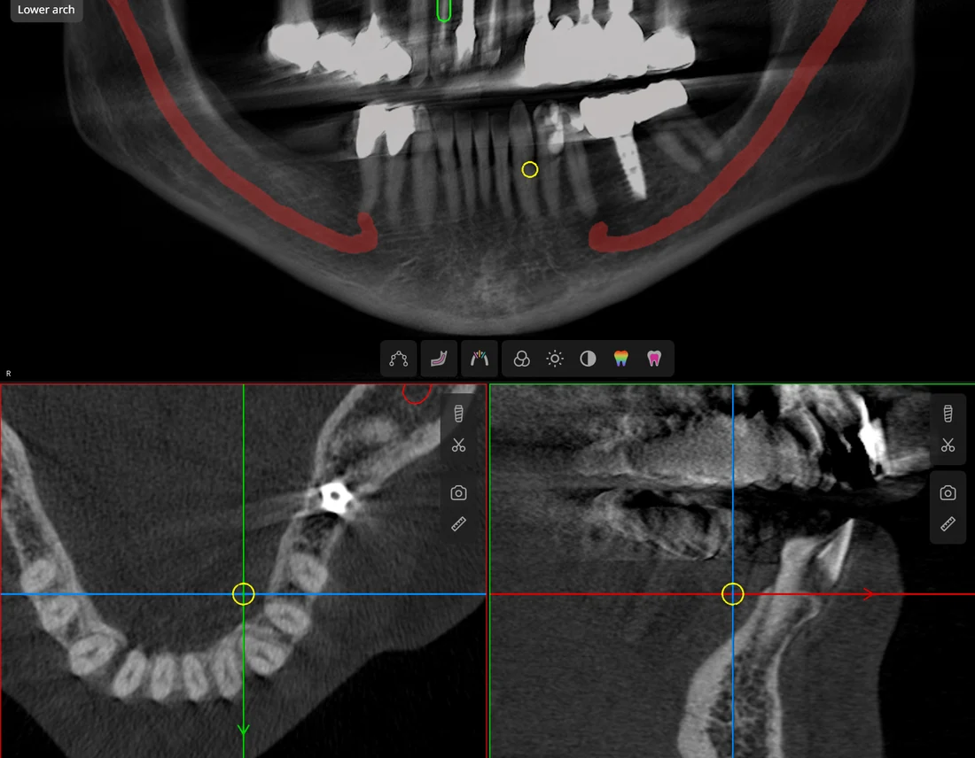 CBCT planning view with panoramic and cross-sectional slices and the nerve canal traced — Smile Spot Dentistry, Venice, FL