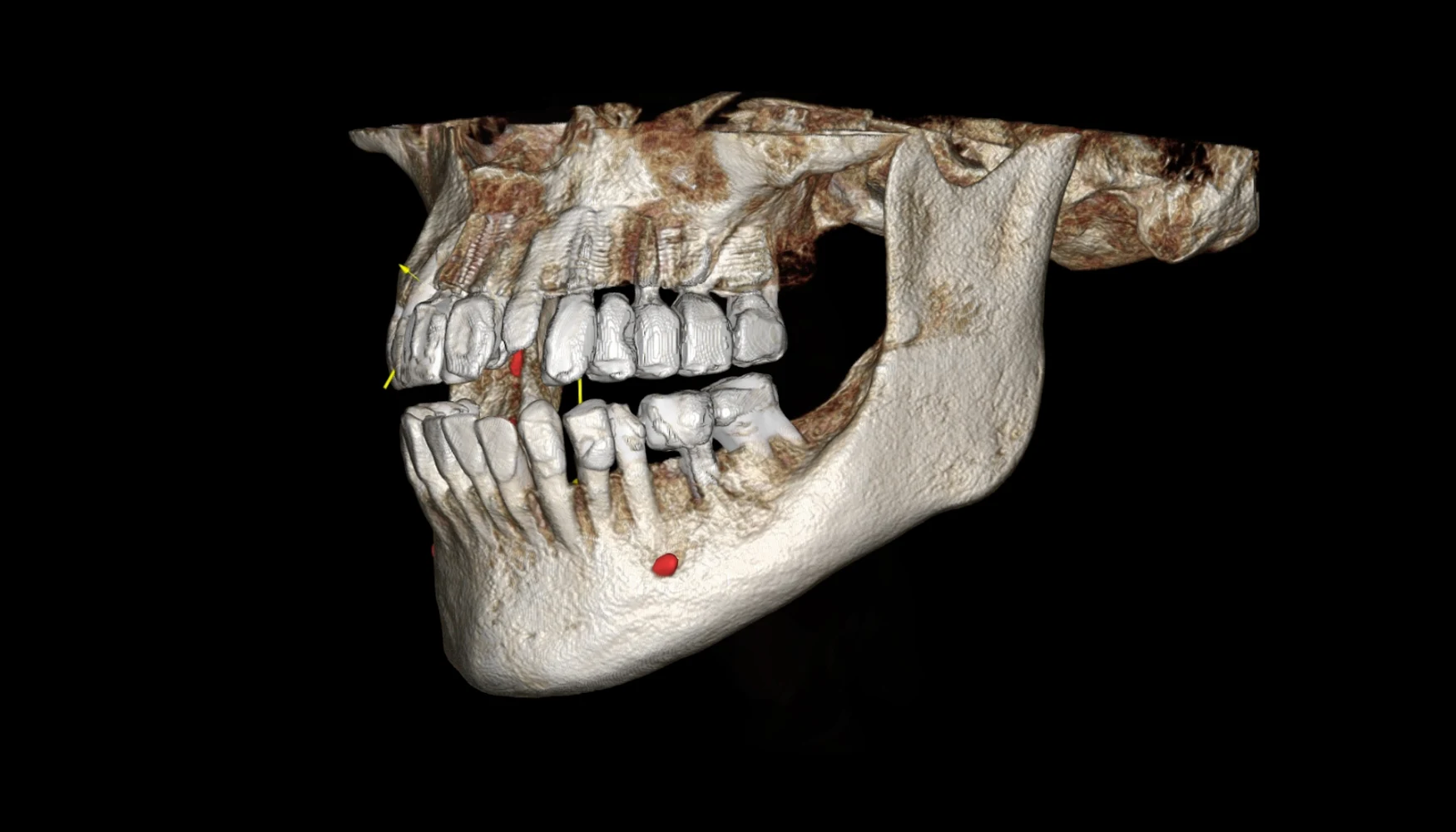 3D CBCT rendering of the jaw showing bone volume for implant planning — Smile Spot Dentistry, Venice, FL