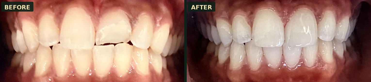 Before-and-after of a chipped front tooth repaired with cosmetic bonding at Smile Spot Dentistry, Venice FL