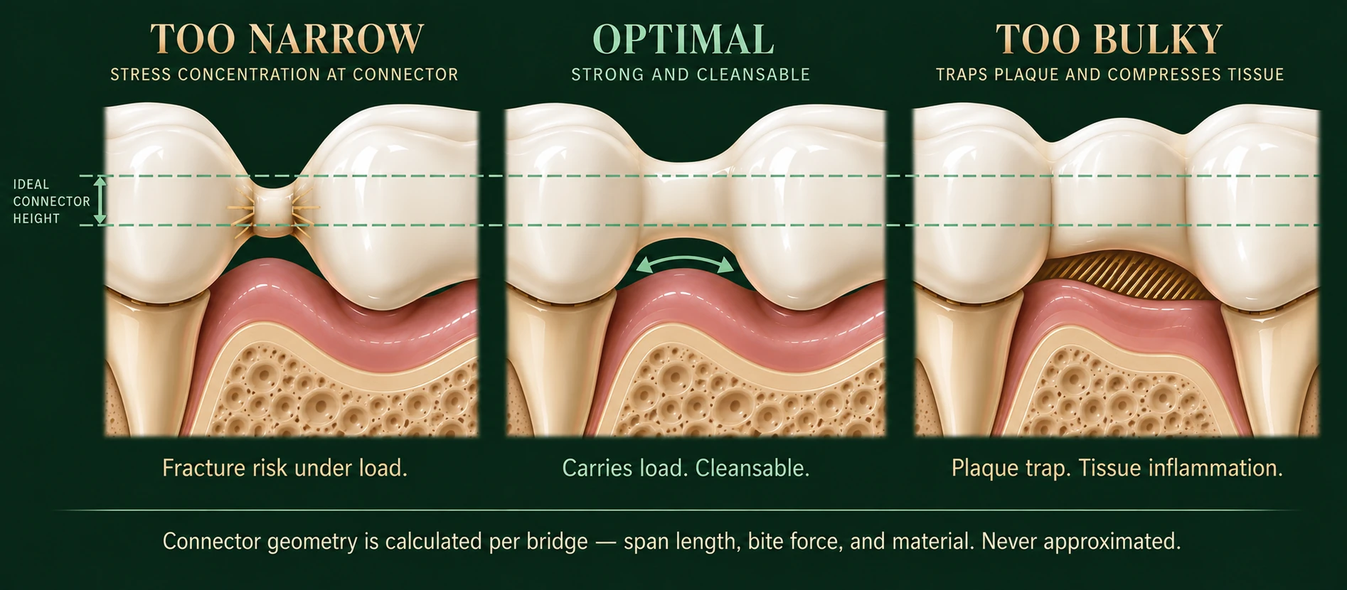 Three-panel comparison of dental bridge connector width — a connector milled too narrow, pinched at the waist with stress concentrating where fracture begins; an optimal connector filling the ideal height with an open, cleansable embrasure beneath it; and a connector built too bulky, closing off the embrasure into a plaque trap and compressing the gum tissue — Smile Spot Dentistry, Venice FL