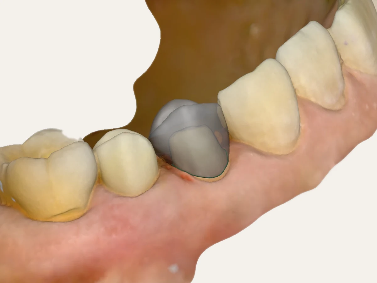 iTero digital scan of a prepared tooth with the crown margin traced — Smile Spot Dentistry, Venice FL