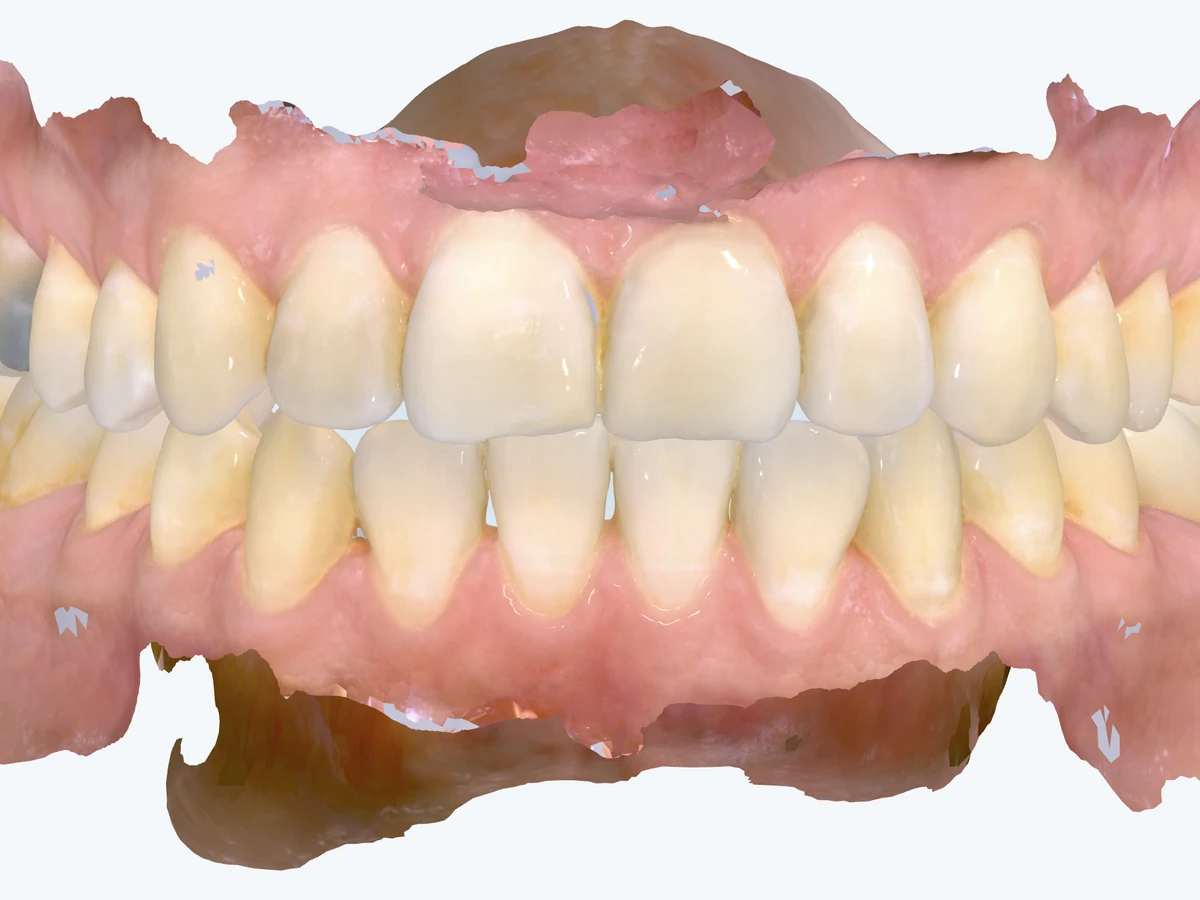 iTero 3D digital scan of the upper and lower teeth — Smile Spot Dentistry, Venice FL