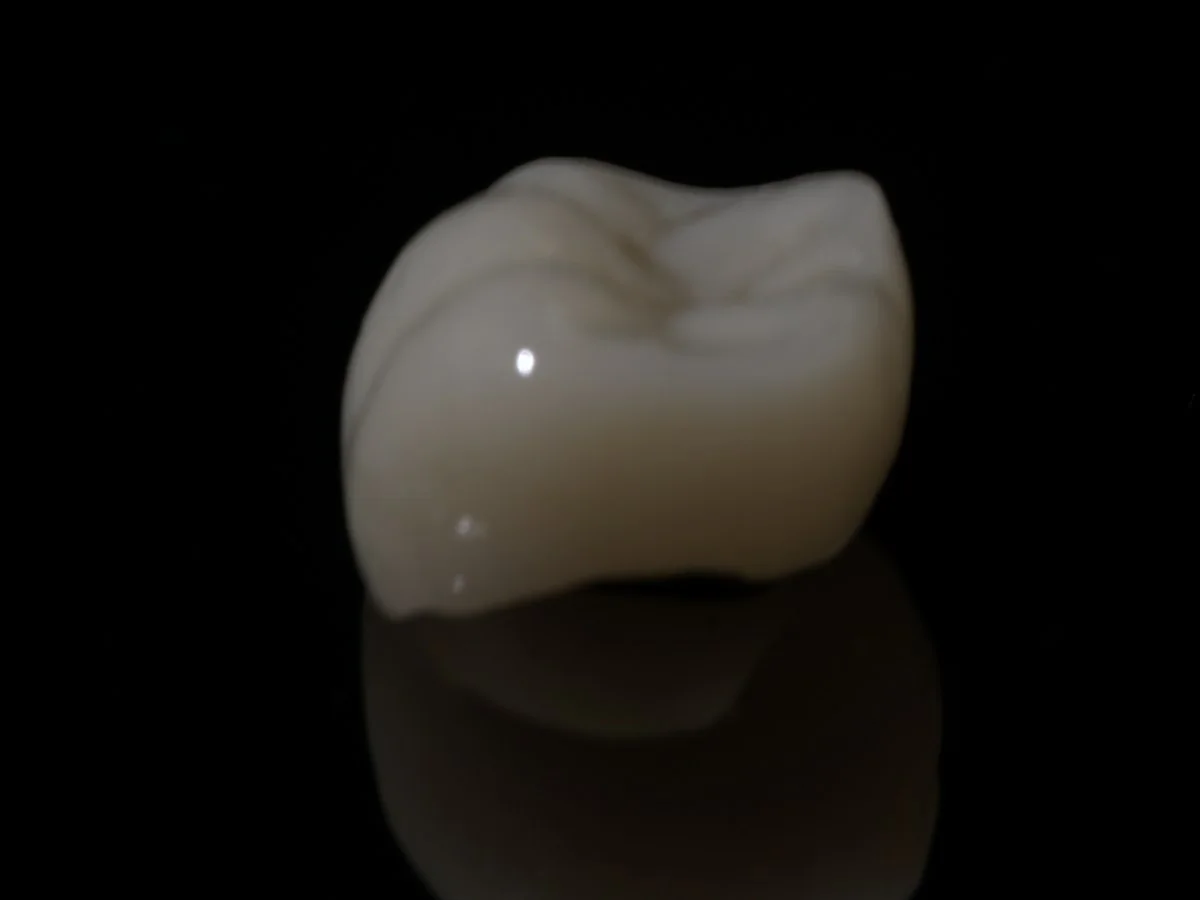 Same-day crown polished and bonded — Smile Spot Dentistry, Venice FL