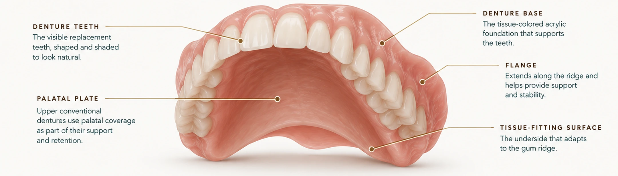 Upper complete denture with its parts labelled — denture teeth, denture base, flange, palatal plate and tissue-fitting surface — Smile Spot Dentistry, Venice FL