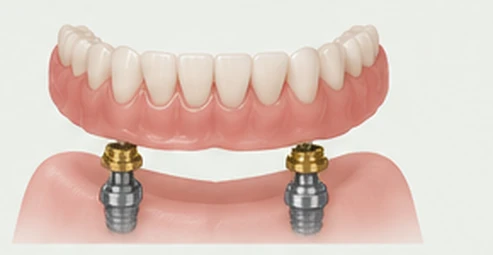 Snap-in overdenture anchored to locator attachments on two dental implants — Smile Spot Dentistry, Venice FL