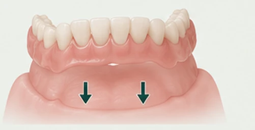 Complete denture held by close tissue fit and suction against the gum ridge — Smile Spot Dentistry, Venice FL