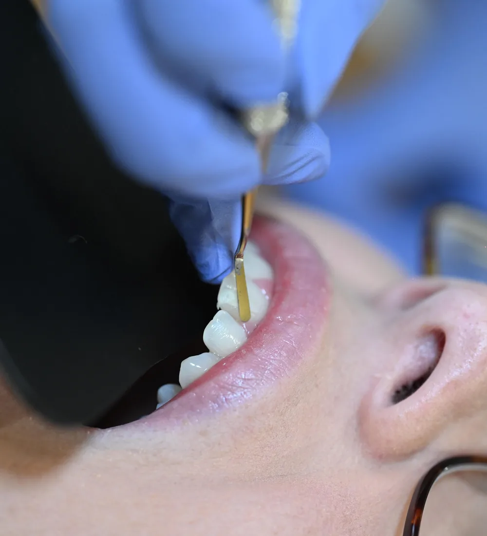 Dr. Meenachi Sellappan performing cosmetic bonding by hand at Smile Spot Dentistry, Venice, Florida