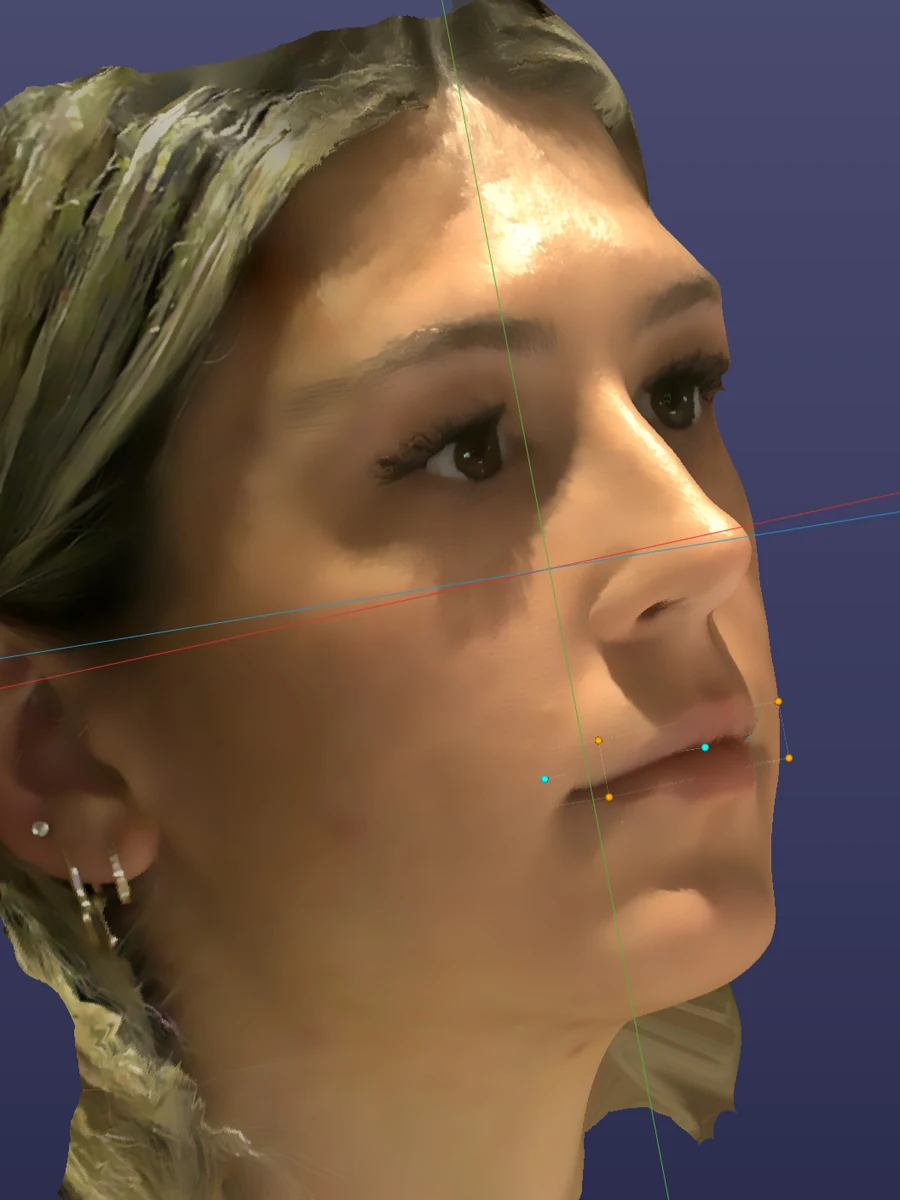 RAYFace smile design software mapping facial reference lines and lip landmarks — digital smile design at Smile Spot Dentistry, Venice, FL