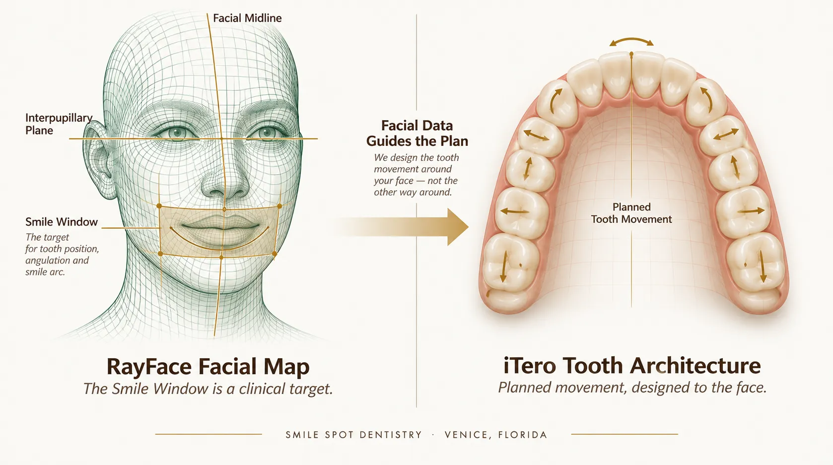 Facially-driven Invisalign planning — RayFace 3D facial map with Smile Window, interpupillary plane and facial midline, guiding planned tooth movement on the iTero arch scan — Smile Spot Dentistry, Venice FL