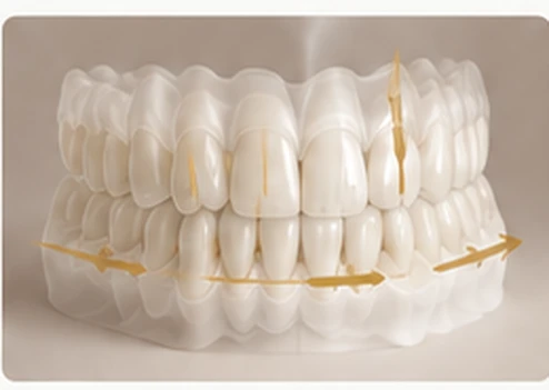 Full-arch model showing anterior guidance and force distribution across the bite — Smile Spot Dentistry, Venice FL