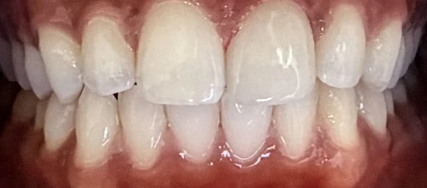 After: the fractured tooth restored by a single all-ceramic crown.