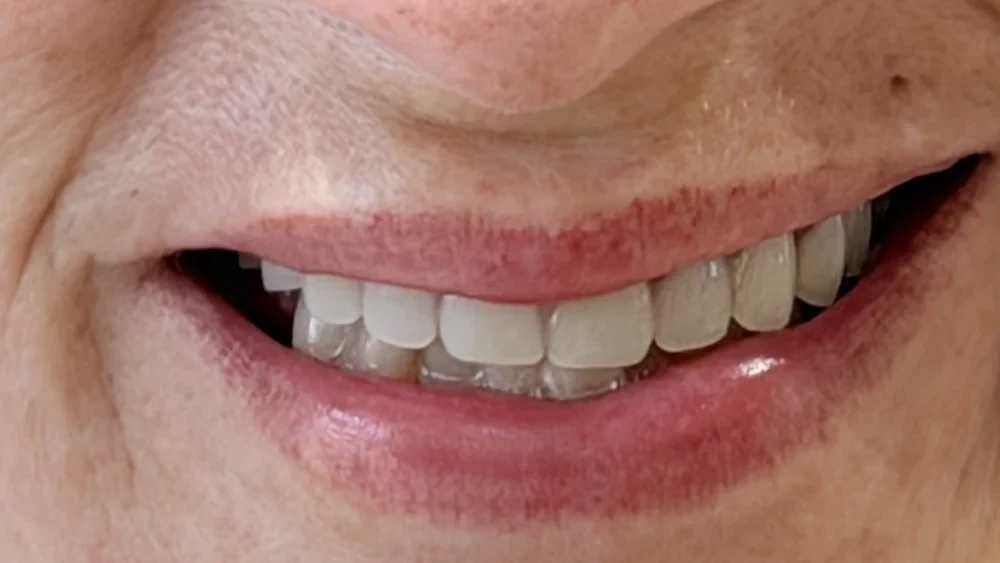 After: complete dentures seated in both arches.