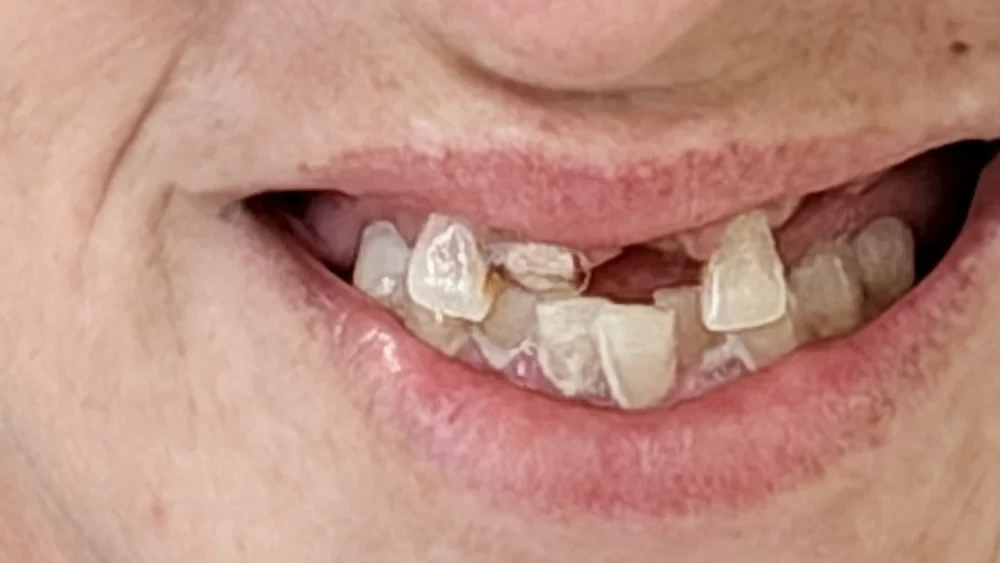 Before: remaining upper and lower teeth fractured and broken down beyond restoring.