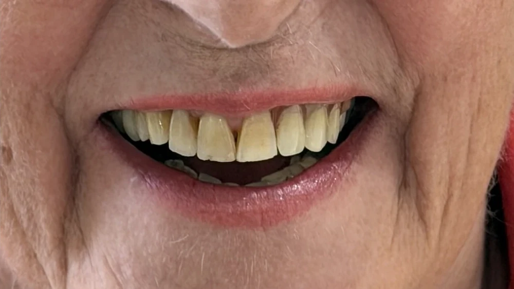 After: an immediate partial denture in place, the gap closed.
