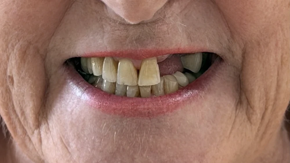 Before: a gap in the upper arch where teeth had fractured.