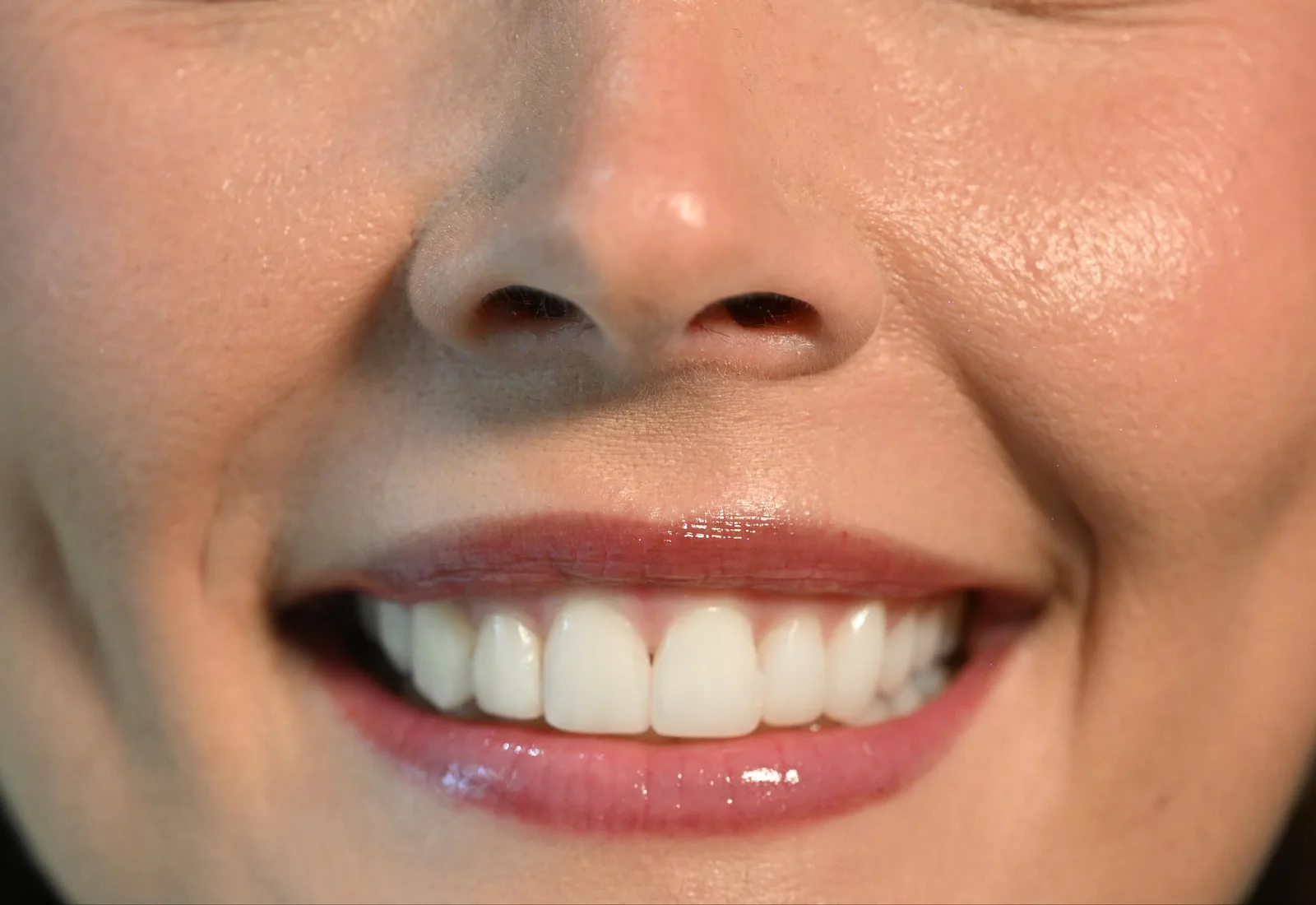 Close-up of a balanced, natural smile after gum contouring — Smile Spot Dentistry, Venice, Florida