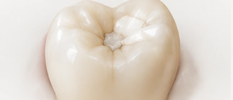 Molar restored with a direct bonded composite filling — restoration hierarchy, Smile Spot Dentistry, Venice FL