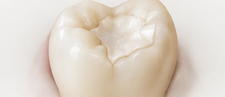 Molar restored with an inlay, cusps intact — restoration hierarchy, Smile Spot Dentistry, Venice FL