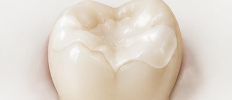 Molar restored with an onlay covering a weakened cusp — restoration hierarchy, Smile Spot Dentistry, Venice FL