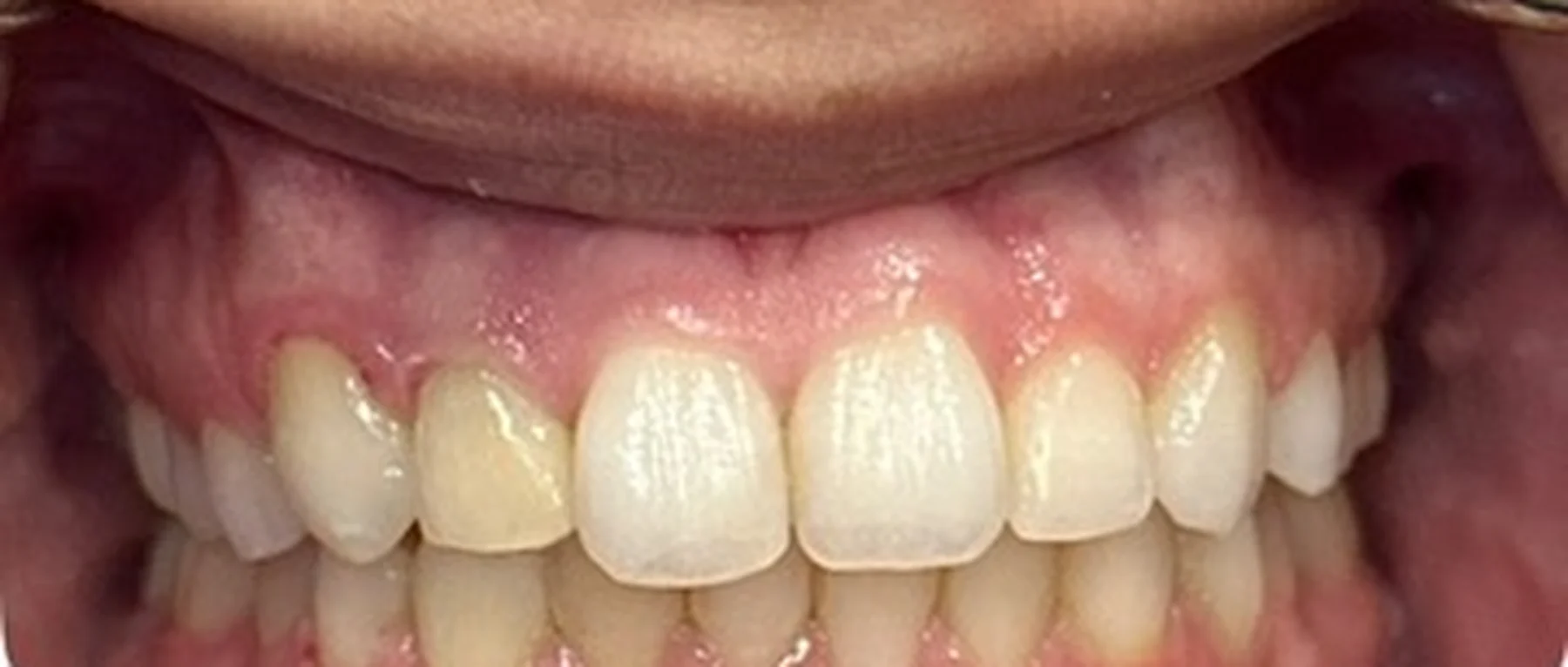After Invisalign — spaces closed and bite aligned at Smile Spot Dentistry, Venice FL