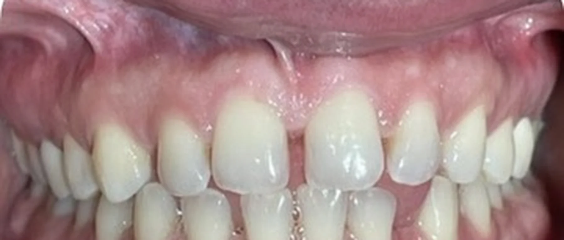 Before Invisalign — spacing between the upper front teeth and a crossbite on the right