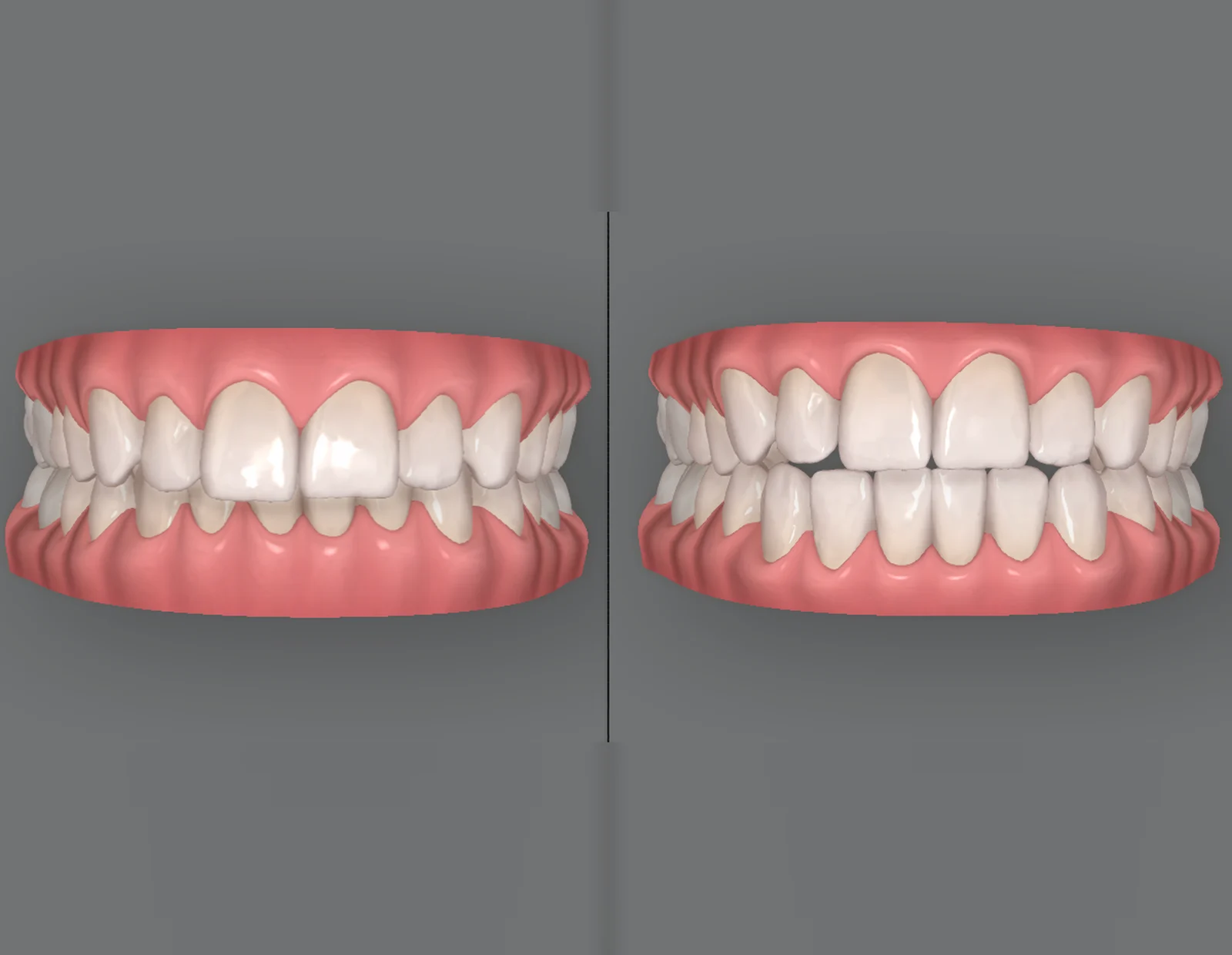 ClinCheck treatment plan showing teeth before and after Invisalign at Smile Spot Dentistry, Venice, FL