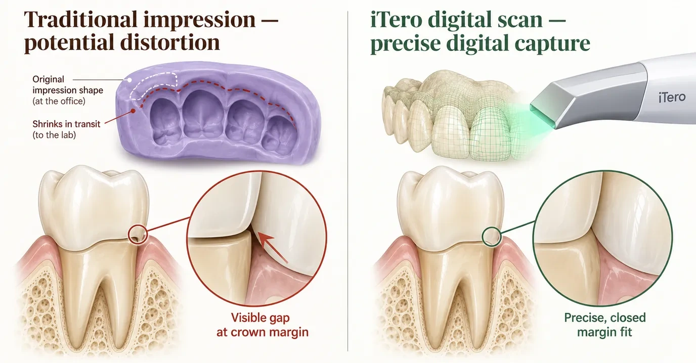 Conventional putty impression compared with an iTero digital scan showing margin fit — Smile Spot Dentistry, Venice, FL
