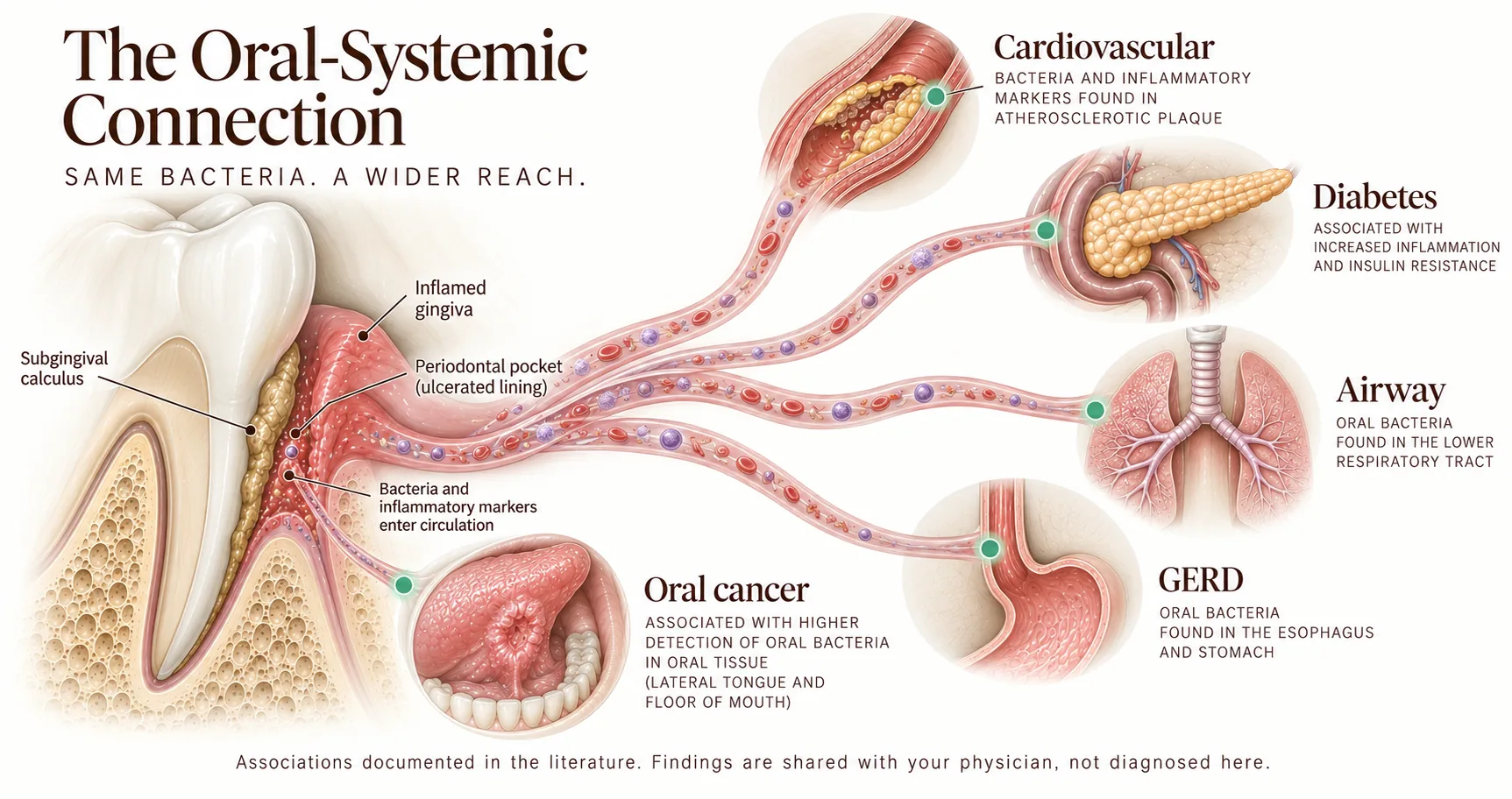 Diagram of the oral-systemic connection. A cross-section on the left shows a periodontal pocket with inflamed gingiva, subgingival calculus and an ulcerated lining where bacteria and inflammatory markers enter circulation. Four vascular channels carry them outward to sites where associations with them have been documented: atherosclerotic plaque in a coronary artery, pancreatic tissue in diabetes, the lower respiratory tract, and the oesophagus and stomach in reflux. A fifth, local connection links the same site to oral tissue of the lateral tongue and floor of mouth. Associations documented in the literature; findings are shared with the patient's physician, not diagnosed at the practice. Smile Spot Dentistry, Venice FL.