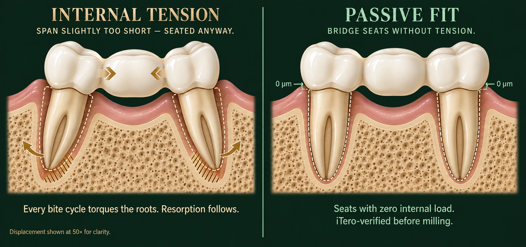 Cross-section comparison of two identical three-unit bridges — on the left a bridge milled with too short a span, seated under internal tension, with both abutment roots tilted away from their correct position and lateral torque driving bone resorption at the root apices; on the right the same bridge with a passive fit, roots upright and seating with zero internal load — Smile Spot Dentistry, Venice FL