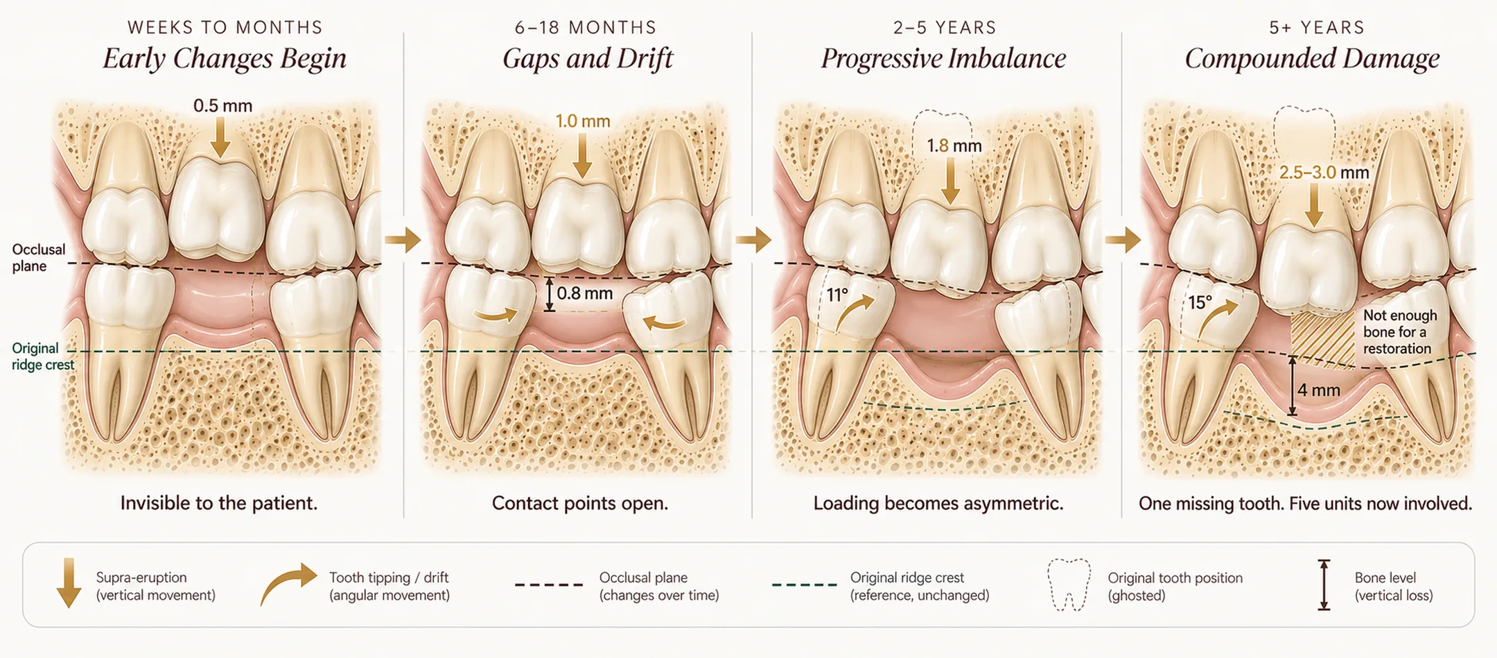 Four-panel timeline of pathological migration after a lower first molar is lost — within weeks the opposing upper molar begins to over-erupt into the space and bone at the ridge starts to resorb; by 6 to 18 months the adjacent teeth tip toward the gap and contact points open; by 2 to 5 years the occlusal plane has collapsed and bite loading is asymmetric; and by 5 years the ridge has lost roughly 40 percent of its width and there is no longer enough space to place a bridge or implant without first correcting five teeth — Smile Spot Dentistry, Venice FL