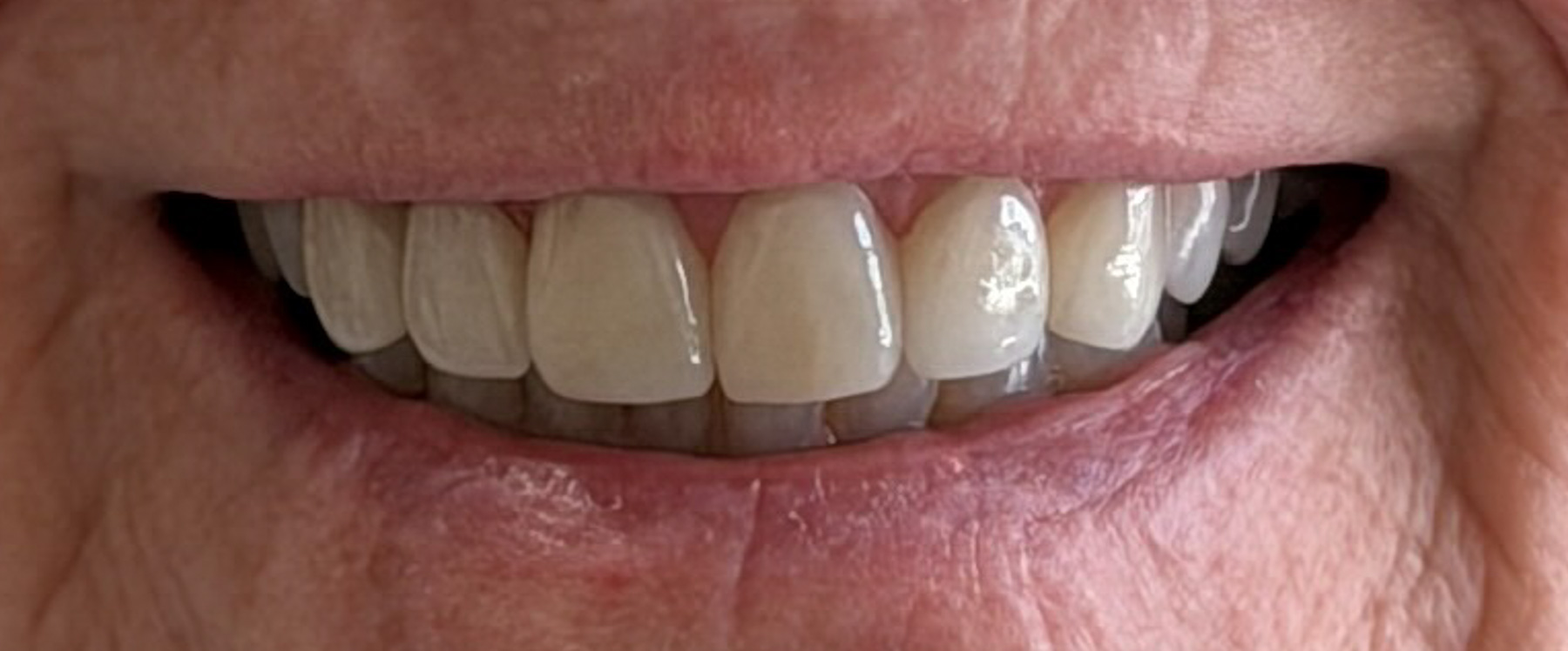 After treatment — eight porcelain veneers with professional whitening at Smile Spot Dentistry, Venice FL