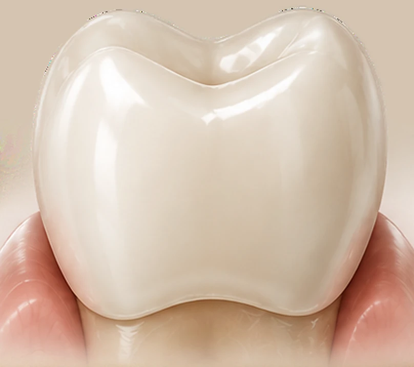 Tooth fully covered by a ceramic crown — Smile Spot Dentistry, Venice FL