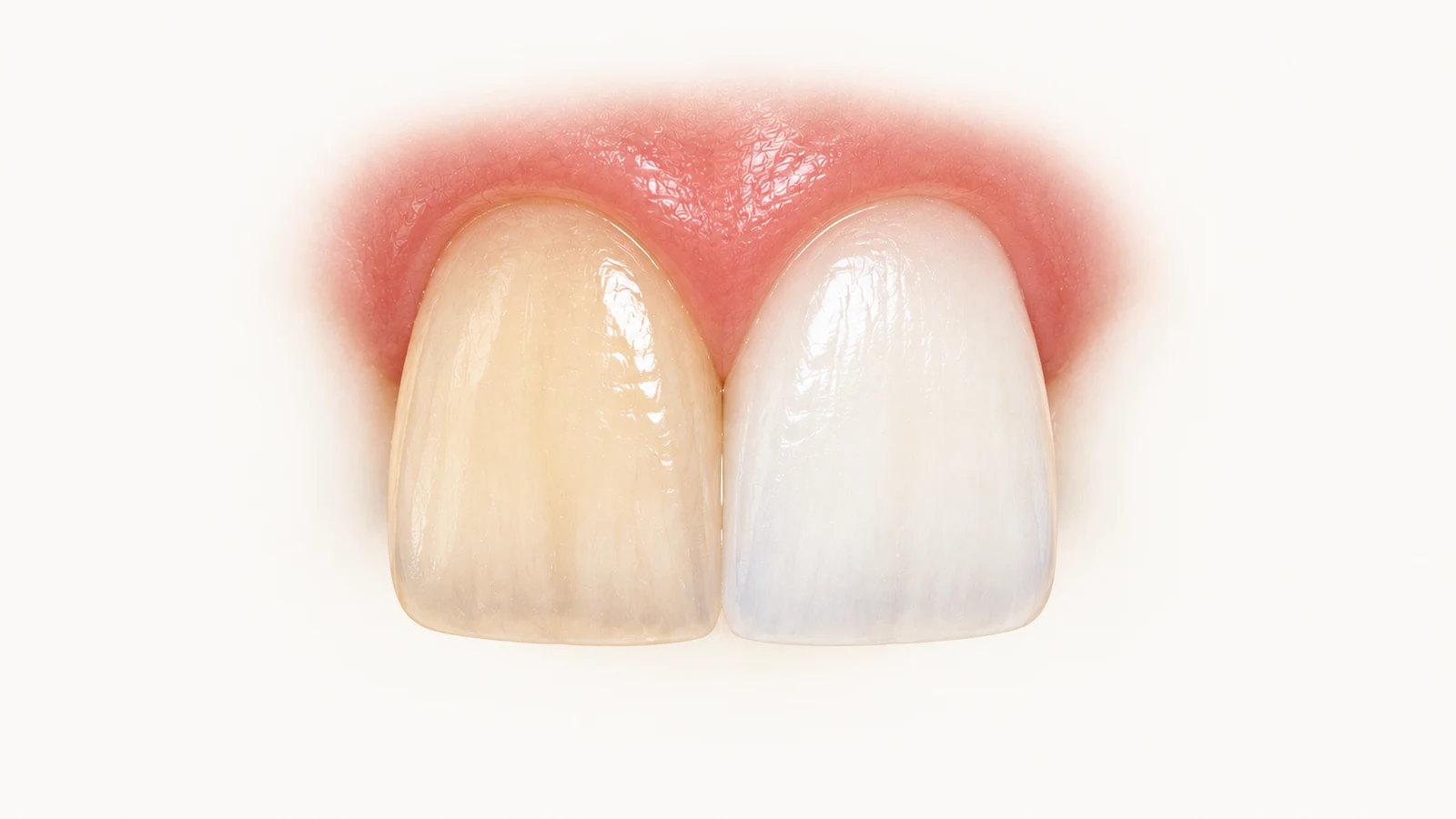 Two central incisors showing the shade difference whitening achieves — Smile Spot Dentistry, Venice, FL