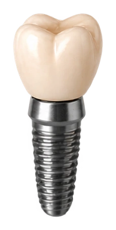 Single Tooth — Healthy Bone — Smile Spot Dentistry, Venice, FL