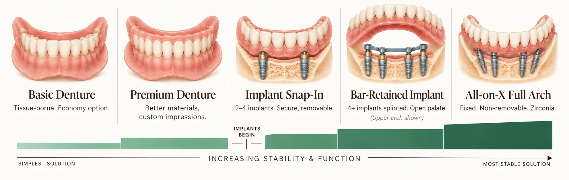 Five denture specifications shown in order of increasing stability and function — a tissue-borne basic denture, a premium denture with better materials and custom impressions, an implant snap-in retained on two to four implants, a bar-retained implant denture splinting four or more implants with an open palate, and a fixed non-removable All-on-X zirconia full arch. A marker on the scale shows where implants begin. Smile Spot Dentistry, Venice FL.