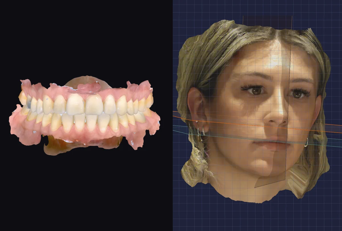 Capture data: iTero 3D model of the dental arches and a RAYFace 3D facial scan