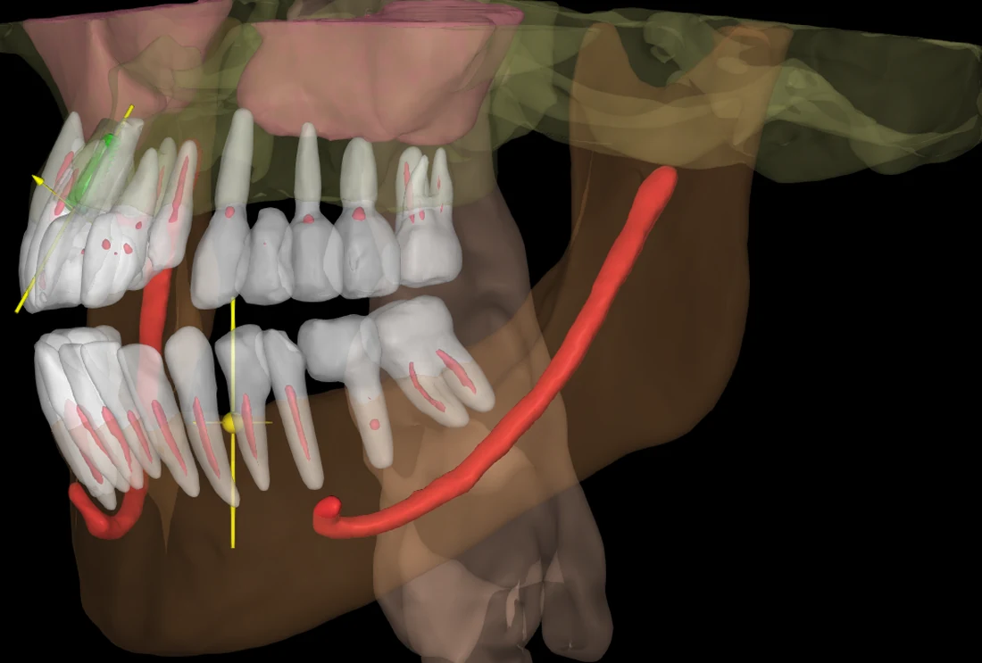 3D CBCT planning model with teeth, bone and the nerve canal traced